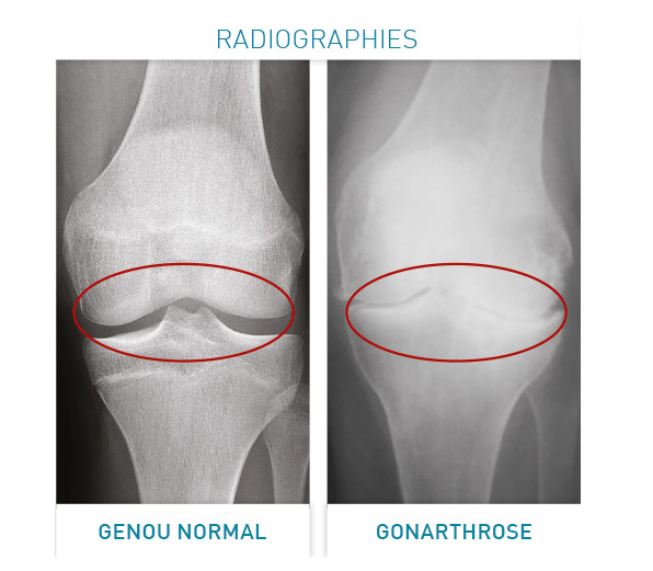 Arthrose et Prothèses de genou – Chirurgie Orthopédique & Sportive